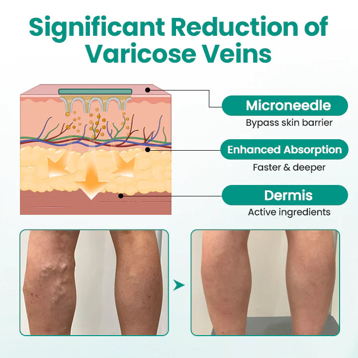 Hotplex® LegRenew Varicose Veins Patch