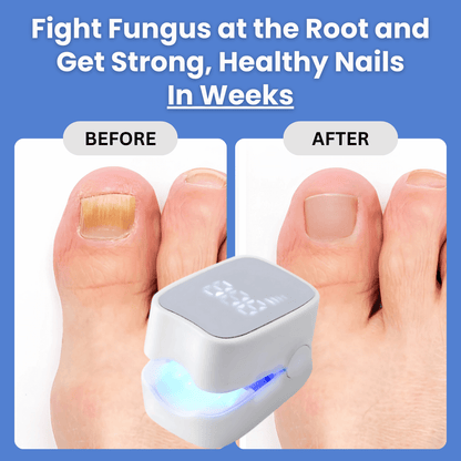 ✨New Arrival: Hotplex™ Nail Fungus Laser Device