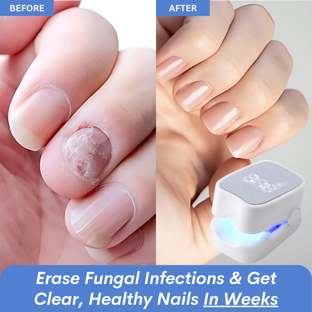 ✨New Arrival: Hotplex™ Nail Fungus Laser Device