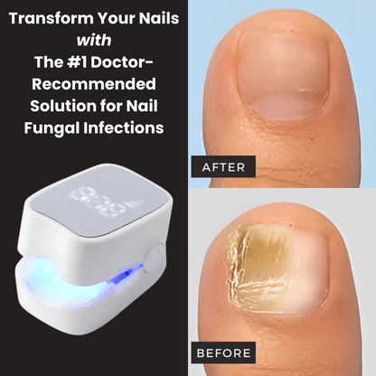 ✨New Arrival: Hotplex™ Nail Fungus Laser Device